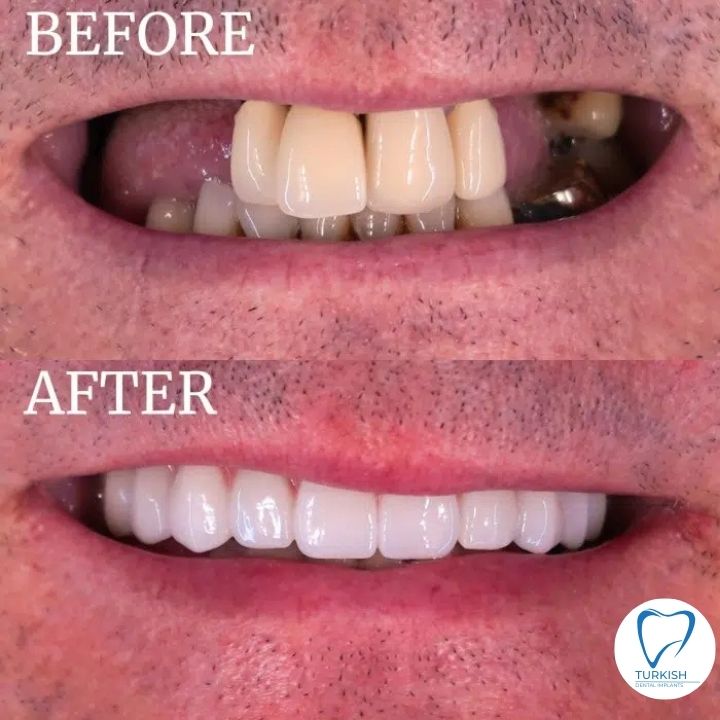 turkey teeth before after