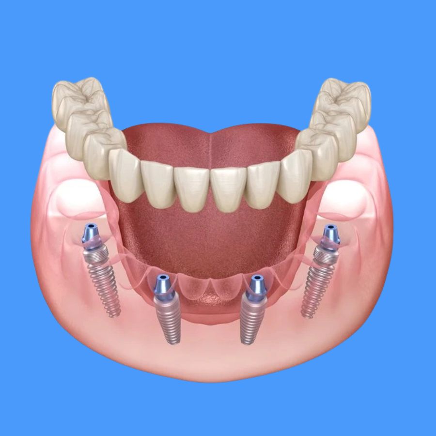 All On 4 dental imoplants In Istanbul, Turkey