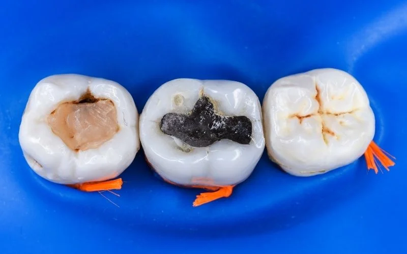 Indications for Tooth Fillings