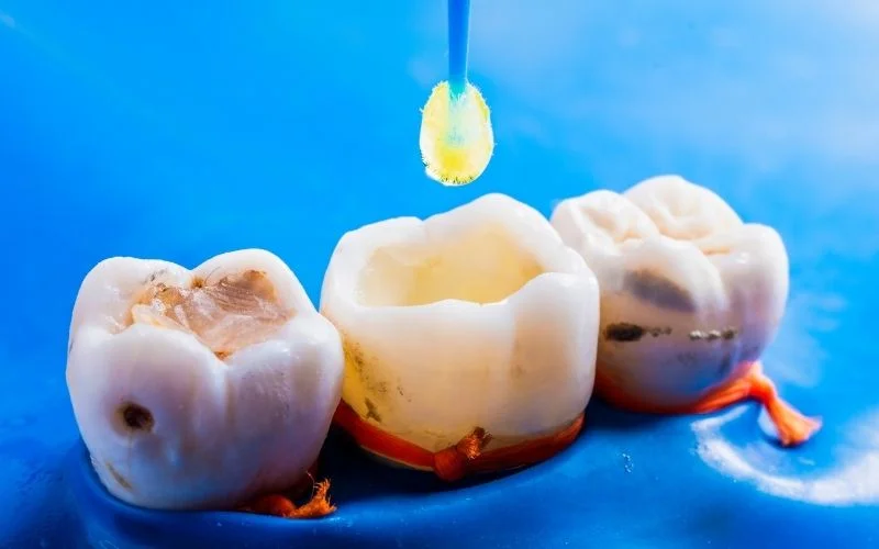 Types Of Tooth Fillings in Turkey: