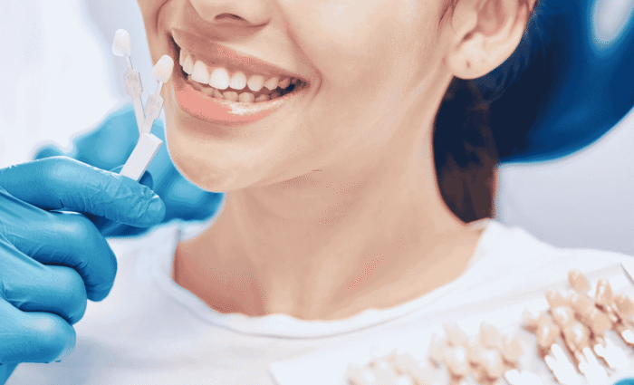 veneers without shaving teeth