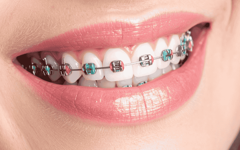 Braces