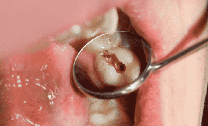 Broken Wisdom Tooth: Treatment Options, Causes and Symtoms