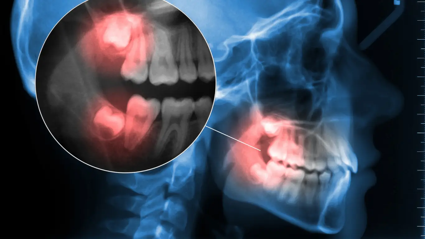 Does-Everyone-Have-Wisdom-Teeth (1)