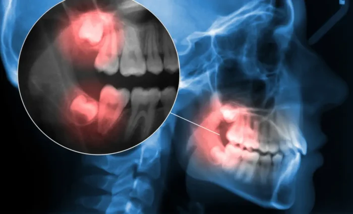 Does-Everyone-Have-Wisdom-Teeth