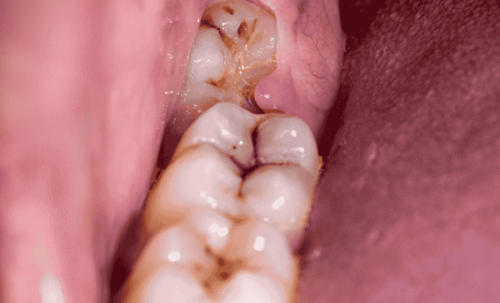 How To Get Food Out Of Wisdom Tooth Hole