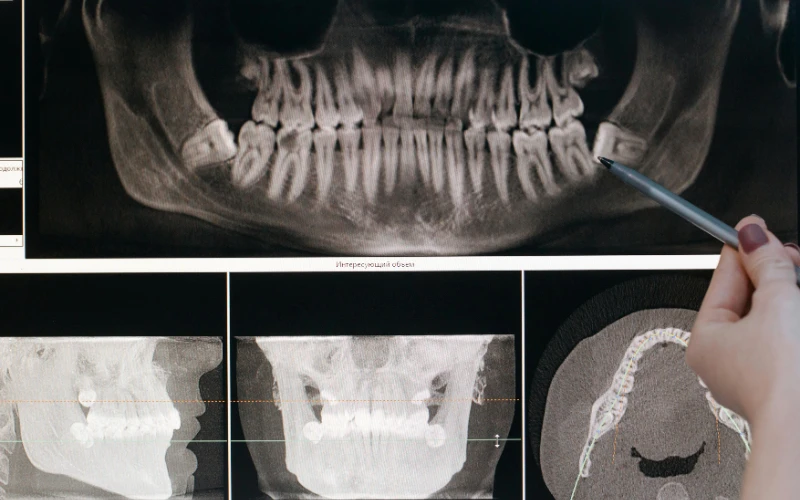 How-to-Tell-If-Your-Wisdom-Teeth-Are-Coming-In-Properly-or-Not
