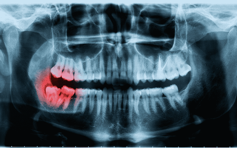 Impacted Wisdom Teeth