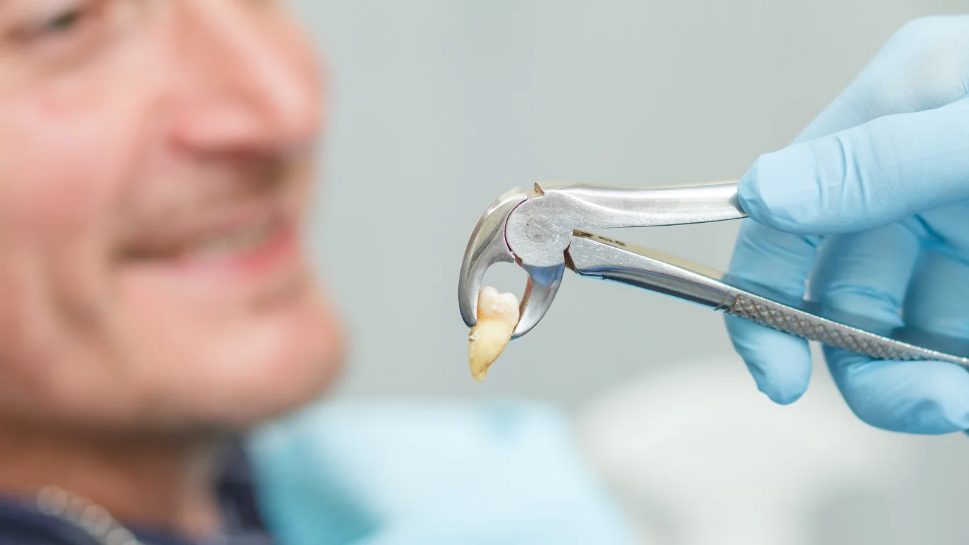 The-Wisdom-Teeth-Extraction-Process (1)