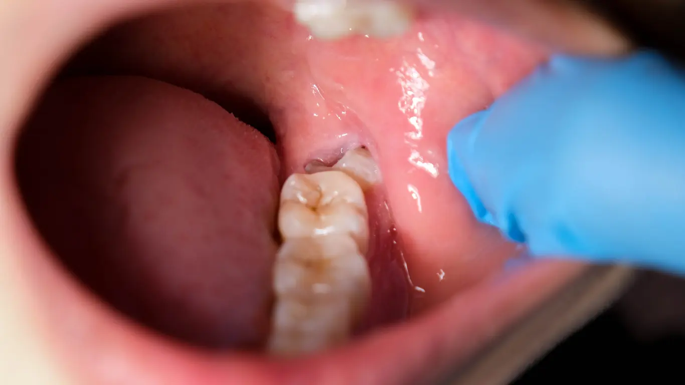 Understanding-Wisdom-Teeth-and-Their-Role-in-the-Mouth