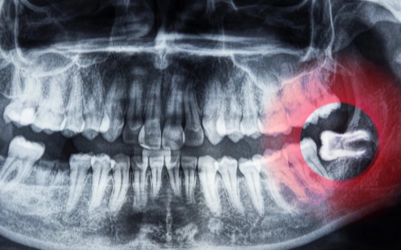 What-Are-Wisdom-Teeth