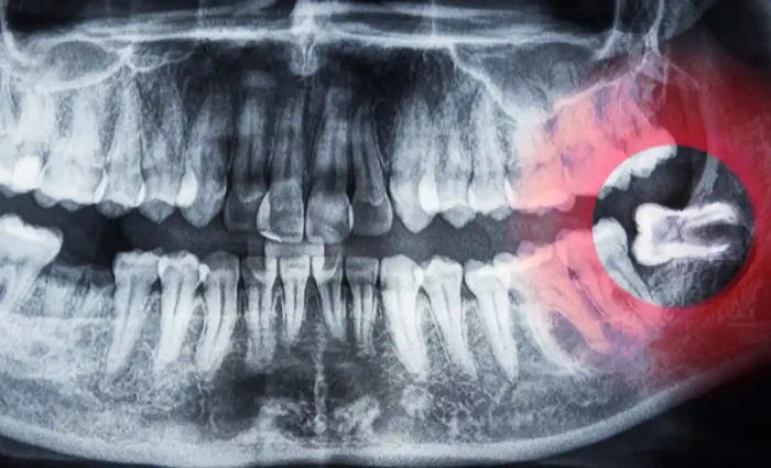 What-Can-I-Eat-After-Wisdom-Teeth-Removal (1)