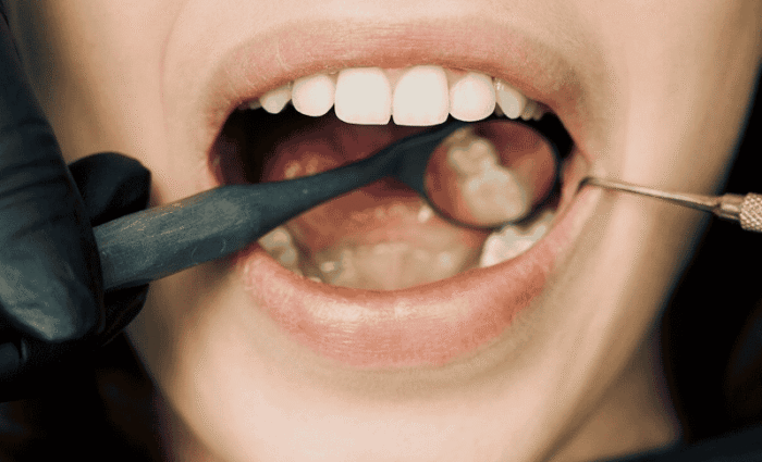 Why Do We Have Wisdom Teeth?