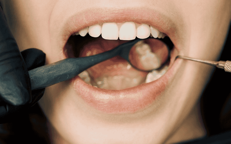 Why Do We Have Wisdom Teeth?