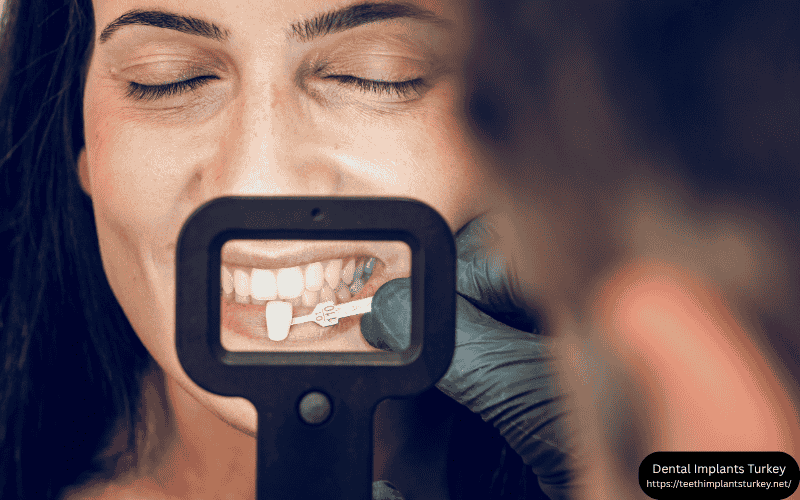 Benefits of Dental Veneers for a Flawless Smile