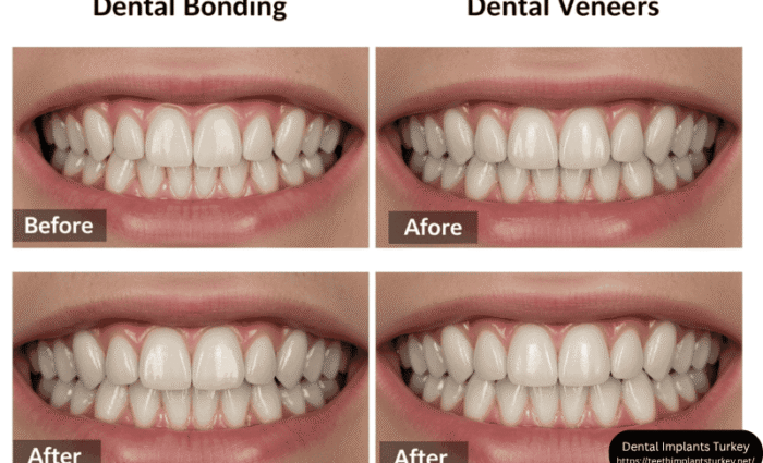 teeth bonding vs veneers