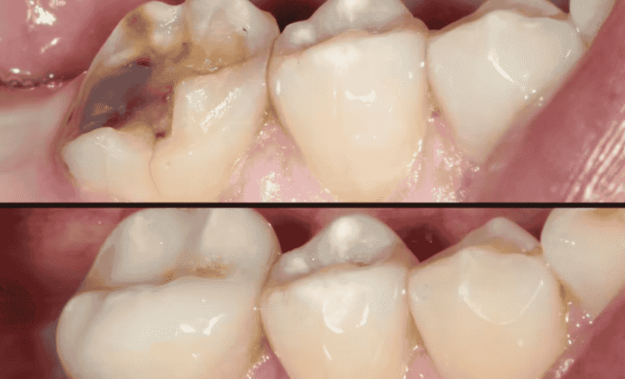 How Yo You Fix Rotten Teeth?