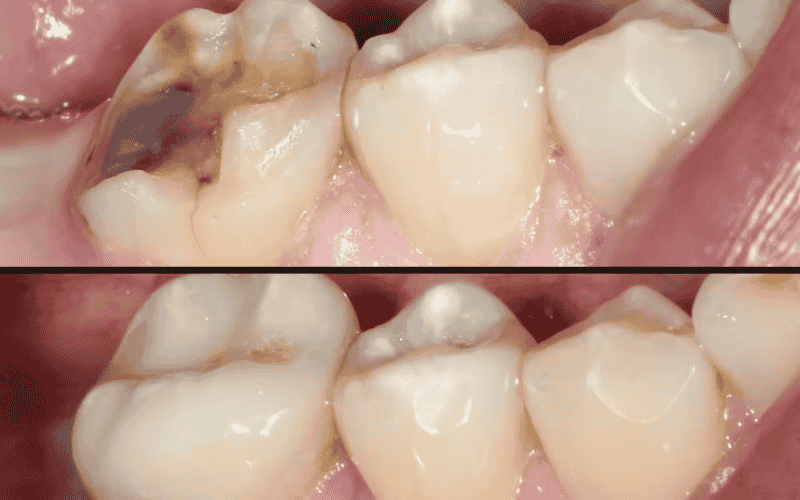 How Yo You Fix Rotten Teeth?