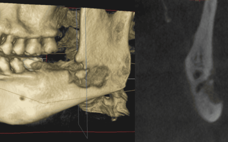 Rare Complications: Osteomyelitis, Jaw Fracture, and TMJ Problems