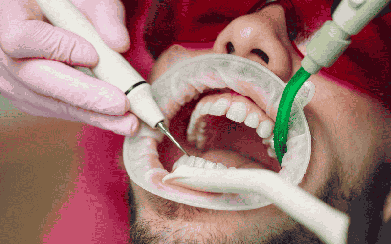 The Main Types of Teeth Stains You Should Know