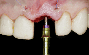 What Is Dental Abutment?