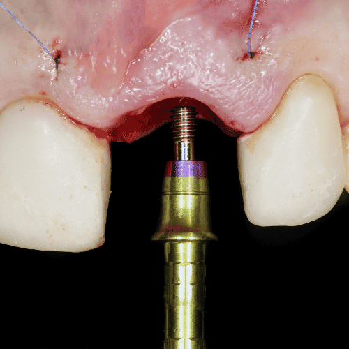 What Is Dental Abutment What Is Dental Abutment?
