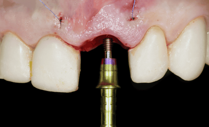 What Is Dental Abutment?