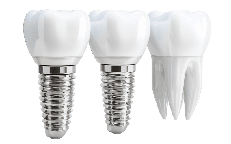 What Materials Are Dental Abutments Made From?