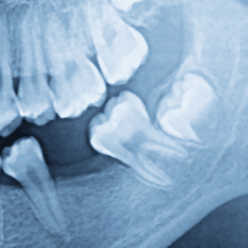 When Do Wisdom Teeth Come In?