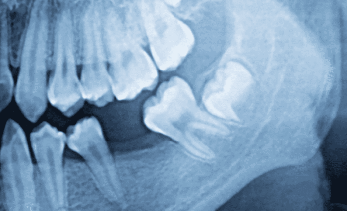 When Do Wisdom Teeth Come In?