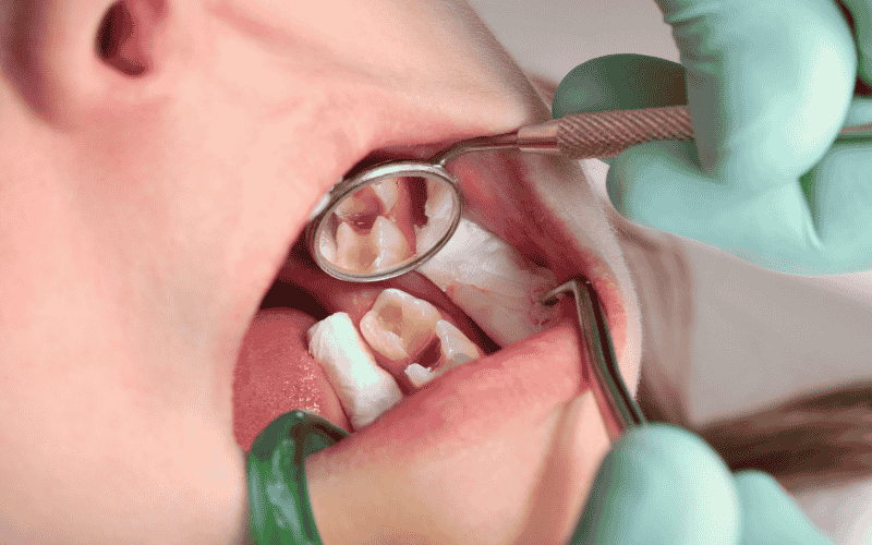 When Is Operculum Removal or Wisdom Tooth Extraction Needed?