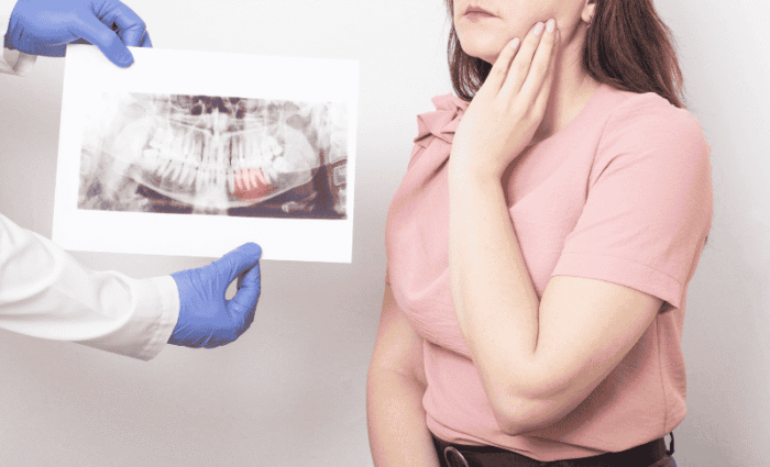 Wisdom Teeth Removal Side Effects