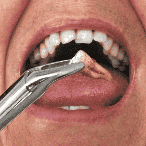 Wisdom Teeth Symptoms That Indicate Time Extraction Wisdom Teeth Symptoms That Indicate Time Extraction