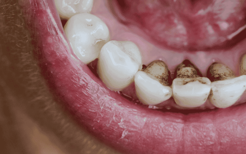 how to get rid of teeth stains?